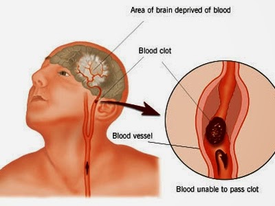 Bệnh Xuất huyết não: Nguyên nhân, biến chứng và cách điều trị